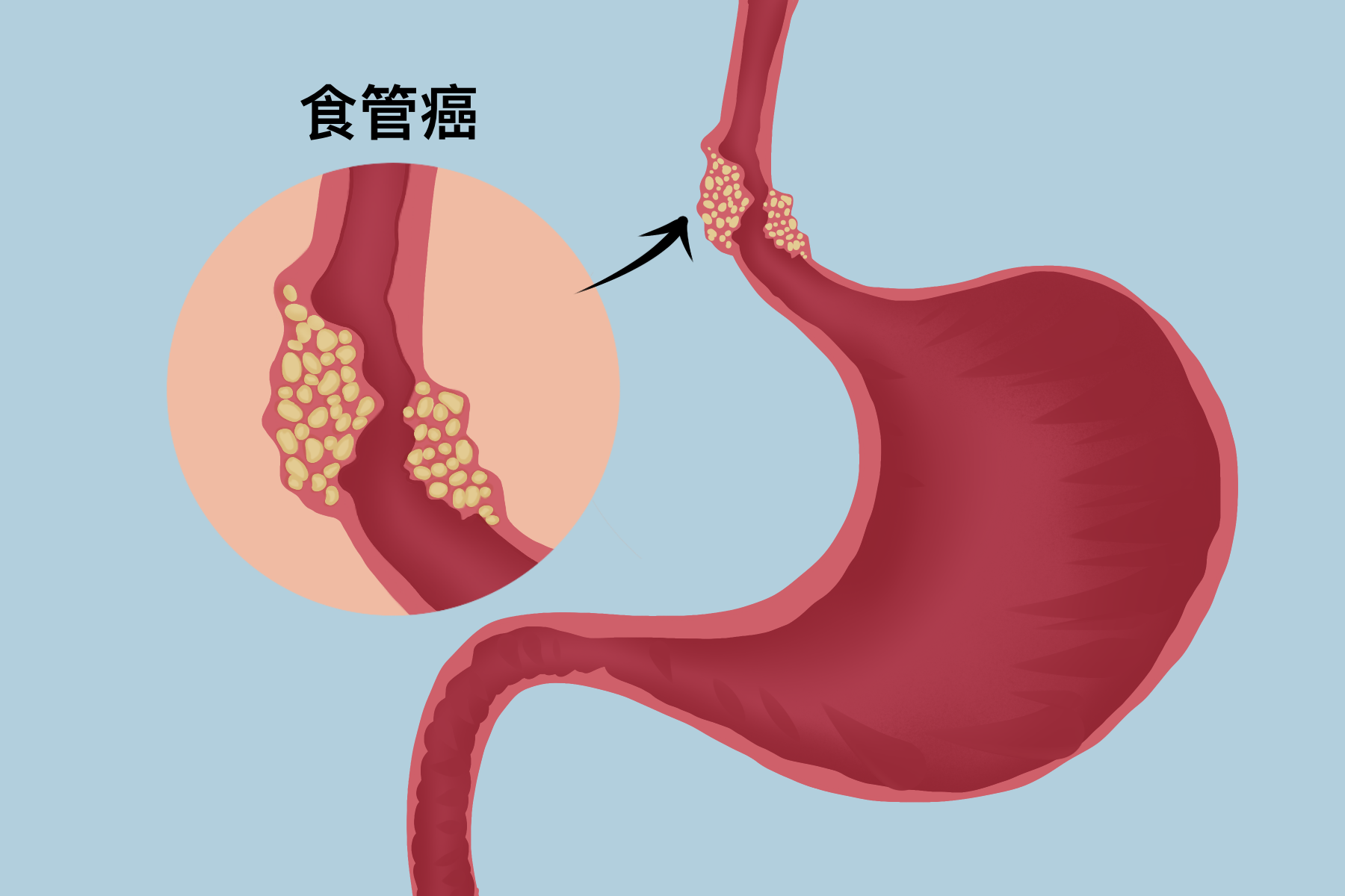 食管癌,什么是食管癌,食管癌有哪些症状